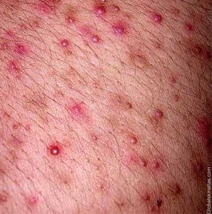 Потница у взрослых - фото, симптомы и лечение проявлений потницы