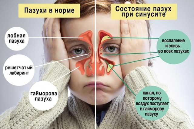 Синусит: симптомы и лечение синусита у взрослых, антибиотики — Симптомы