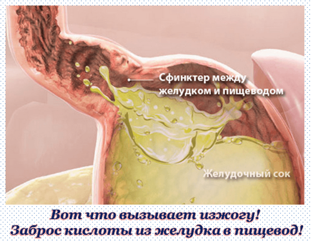 Лечение изжоги народными средствами в домашних условиях