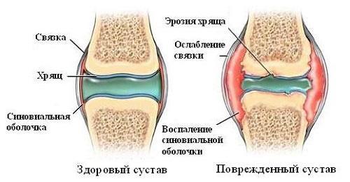 Хруст в суставах причины и лечение — Суставы