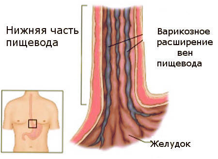Варикозное расширение вен пищевода – особенности лечения