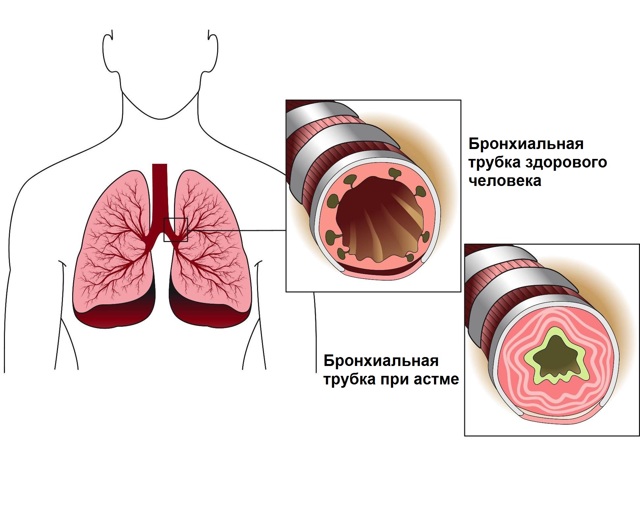 Неотложная помощь при приступе бронхиальной астмы