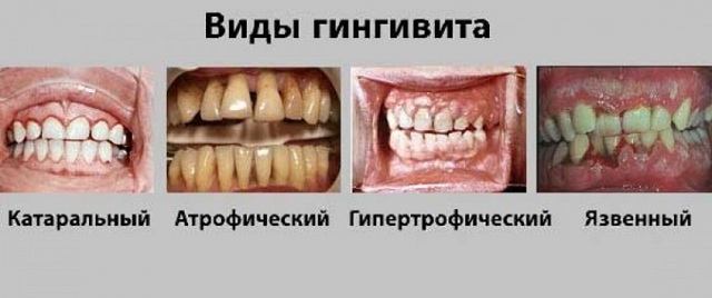 Воспаление десен — Топ-10 причин, симптомы, признаки и что делать при заболевании