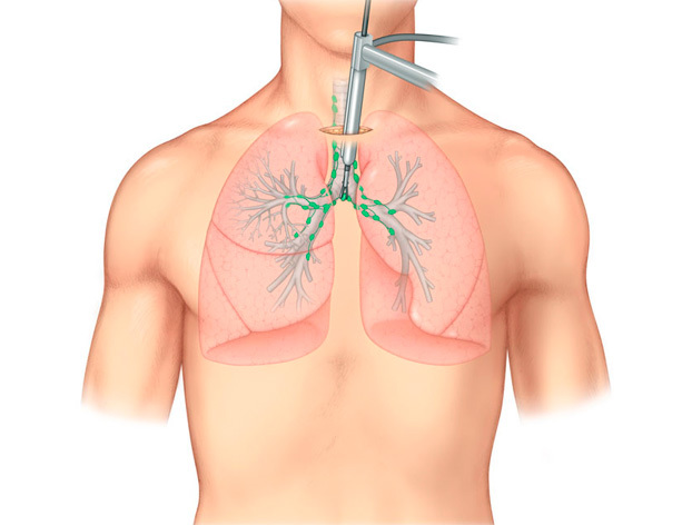 Диагностика рака легких на ранних стадиях, методы диагностики рака легких