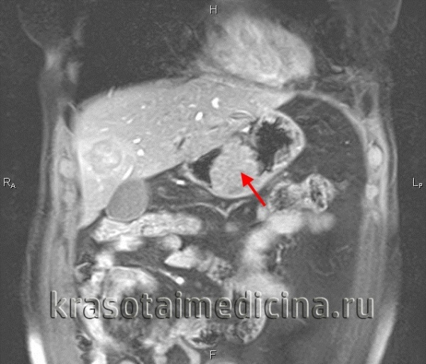 Рак желудка – Болезни онкологии