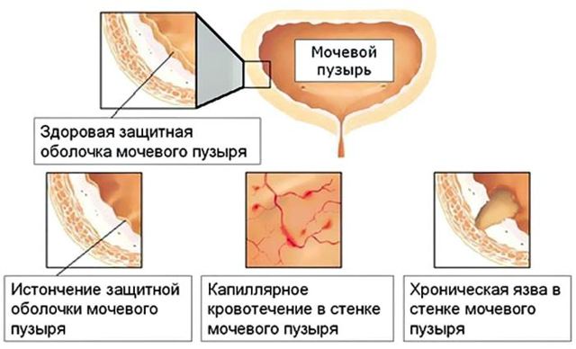 Цистит у мужчин - виды, причины, симптомы и лечение
