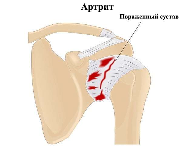 Артрит плечевого сустава (плечевой артрит) – причины, симптомы и методы лечения плечевого артрита