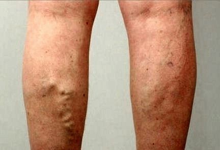 Как лечить варикоз на ногах у женщин и у мужчин и чем он опасен?