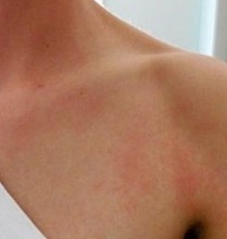 Потница у взрослых - фото, симптомы и лечение проявлений потницы