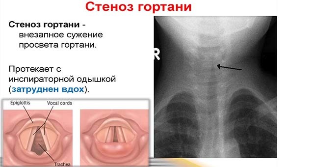 Отек горла у ребенка и взрослого - проявления, симптомы и лечение в домашних условиях