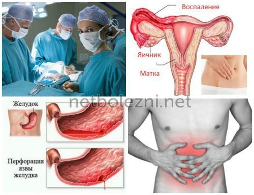 Спаечная болезнь кишечника симптомы и лечение