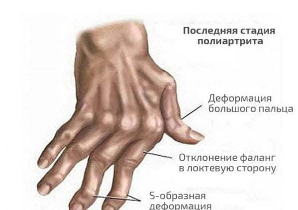Псориатический артрит - причины, симптомы и лечение