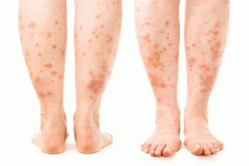 Как лечить варикоз на ногах у женщин и у мужчин и чем он опасен?