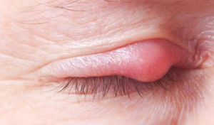 Инструкция по применению мази Преднизолон - показания