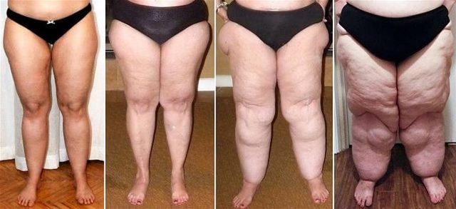 Отек ног в области стопы: причины припухлости правой и левой ступни, что делать, почему отекают ноги у женщин