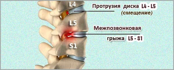 Грыжа позвоночника поясничного отдела лечение