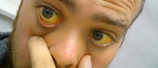 Желтые белки глаз: причины симптомы и лечение