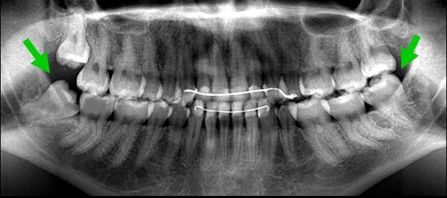 Зуб мудрости - как выглядит: описание, особенности, сроки прорезывания