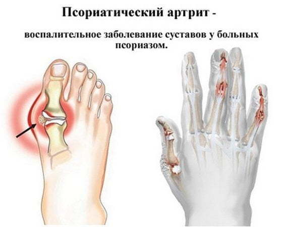 Псориатический артрит - причины, симптомы и лечение