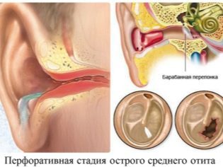 Отипакс для детей: инструкция по применению, отзывы, цена