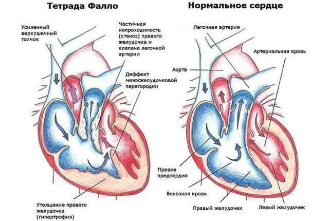 Самые опасные заболевания сердца