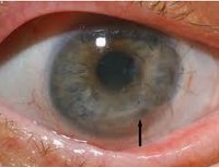 КЕРАТИТ — Большая Медицинская Энциклопедия