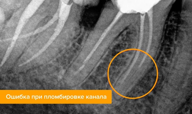 Болит зуб после удаления нерва - причины и лечение, народные средства. Как предотвратить зубную боль после удаления нерва - Автор Екатерина Данилова