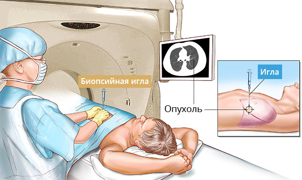 Диагностика рака легких на ранних стадиях, методы диагностики рака легких
