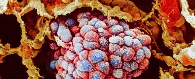 Диагностика рака легких на ранних стадиях, методы диагностики рака легких