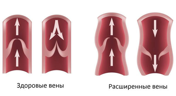 Варикозное расширение вен пищевода – особенности лечения