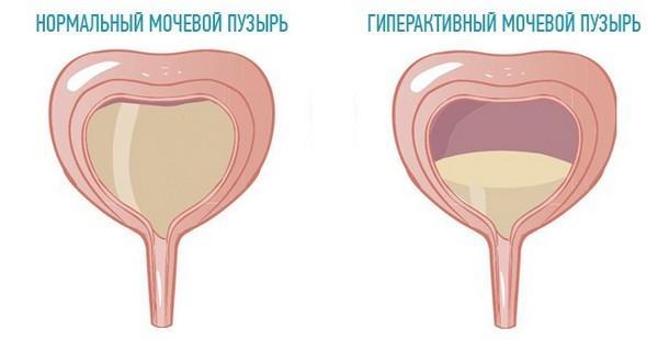 Частое мочеиспускание у мужчин с болью и без боли – причины и методы профилактики. Лечение частого мочеиспускания у мужчин - Автор Екатерина Данилова