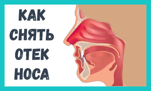 Отек слизистой носа: лечение - как снять отек носа?