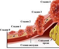 Рак желудка – Болезни онкологии