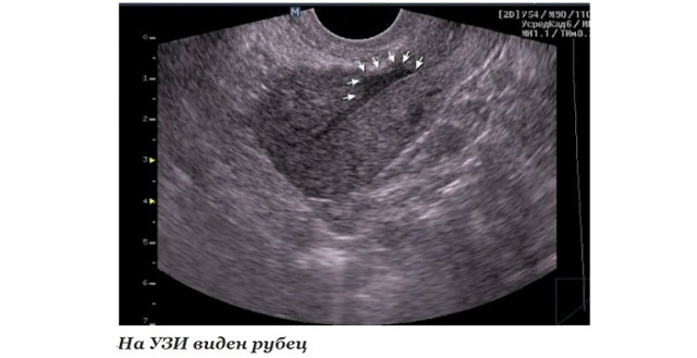 Рубцовые изменения — E-Cardio