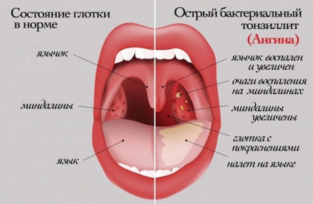 Как лечить боль в горле при глотании без температуры