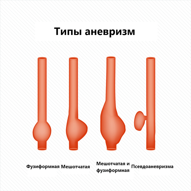 Основные симптомы аневризмы сосудов головного мозга