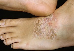 Инструкция по применению мази Преднизолон - показания