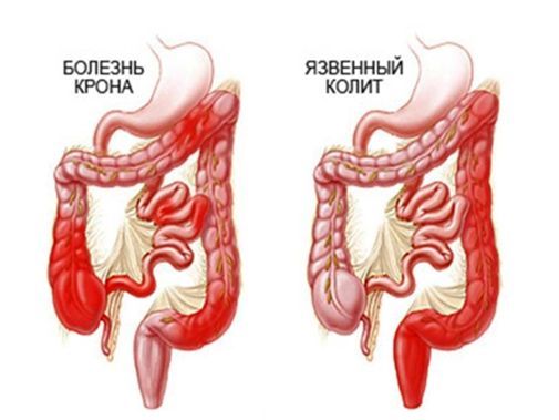 Свечи Салофальк - побочные эффекты, противопоказания и аналоги
