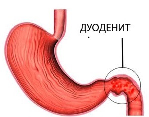 Дуоденит - что это? Симптомы и лечение, препараты, прогноз