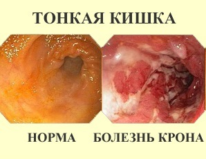 Болезнь Крона - симптомы и лечение у взрослых, причины, диагностика