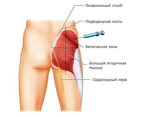 Ортофен: инструкция по применению уколов и геля