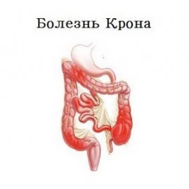 Болезнь Крона - симптомы и лечение у взрослых, причины, диагностика