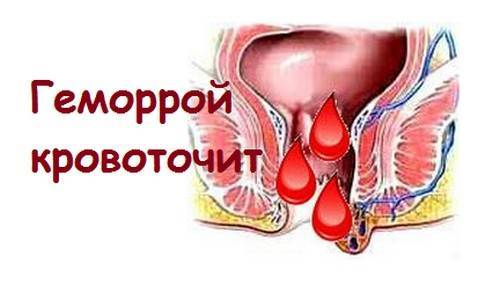 Сильно кровит геморрой и кровоточит узел: что делать