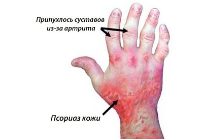 Псориатический артрит - причины, симптомы и лечение