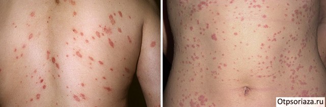 Псориаз у взрослых: фото, признаки, симптомы и лечение
