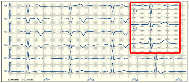 Рубцовые изменения — E-Cardio