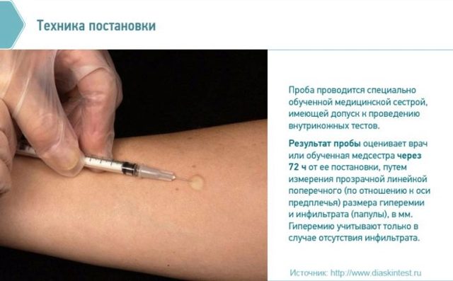 Диаскинтест результаты у детей: норма, положительный, отрицательный