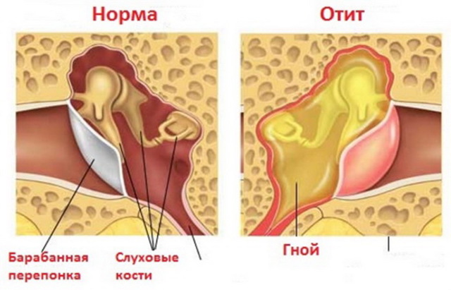 Отит среднего уха: симптомы и лечение у взрослых в домашних условиях