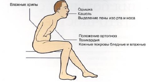 Острая сердечная недостаточность: признаки и симптомы