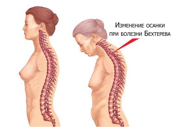 Болезнь Бехтерева – диагностика, симптомы и лечение!